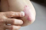 Skin disorders health issues, Skin disorders latest, five common skin disorders and their symptoms, Immune system