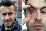 parasites eat man’s eye, contact lens in shower, contact lens wearers beware man goes blind after parasites eat man s eye as he wore lenses in shower, Sleepless nights