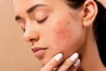 skin, dermatologist, 10 ways to get rid of pimples at home, Skin care