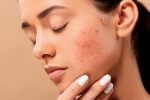 dermatologist, home remedies, 10 ways to get rid of pimples at home, Beauty products dermatologist, home remedies, 10 ways to get rid of pimples at home, Beauty products