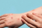Monkeypox sexual transmission, Monkeypox, study says that the symptoms of monkeypox are different from earlier, Bisexual